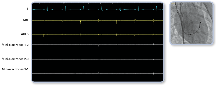 EKG showing InteallaTip MiFi tip entry into right atrium